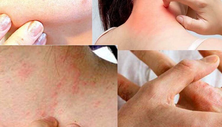 Skin Disorders: Ayurvedic Treatments for Skin Disorders